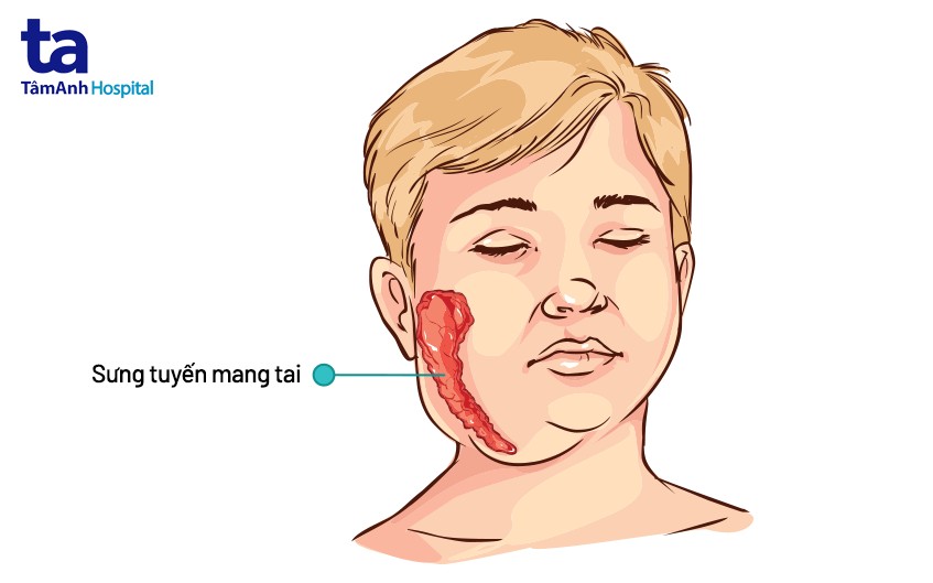 Biểu hiện quai bị ở trẻ em Gallery 2