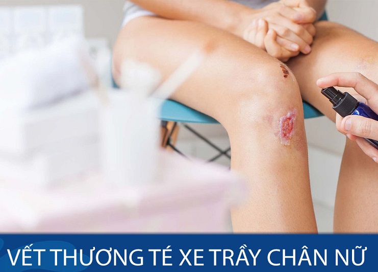 Ngã xe xước chân: Cách sơ cứu và điều trị hiệu quả Gallery 1