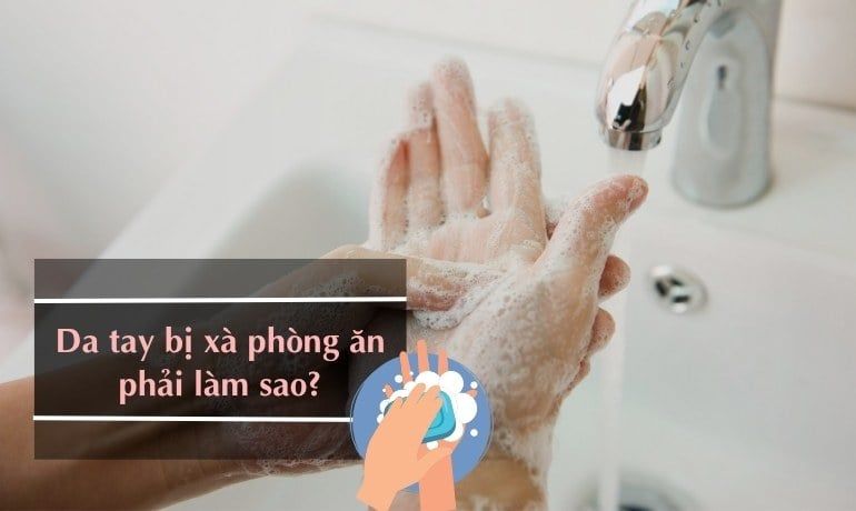 Tay bị xà phòng ăn phải làm sao? Gallery 1
