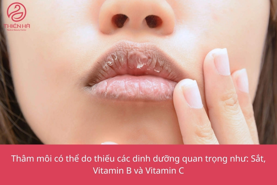 Nứt môi thiếu chất gì? Gallery 1