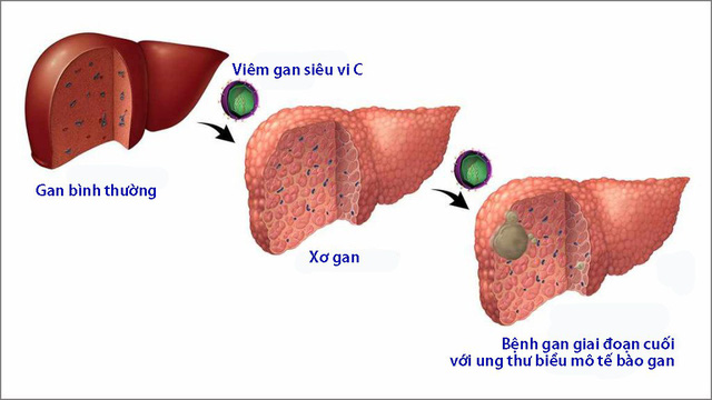 Viêm gan siêu vi C lây qua đường nào? Gallery 1