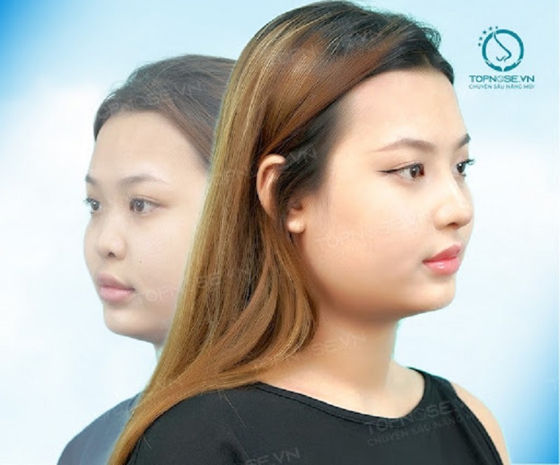 Dáng mũi đẹp cho mặt tròn Gallery 1