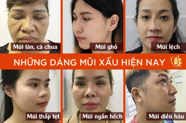 Các Dáng Mũi Xấu Và Cách Khắc Phục