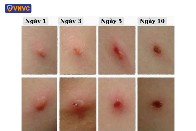 Khi nào thủy đậu hết lây? Gallery 1