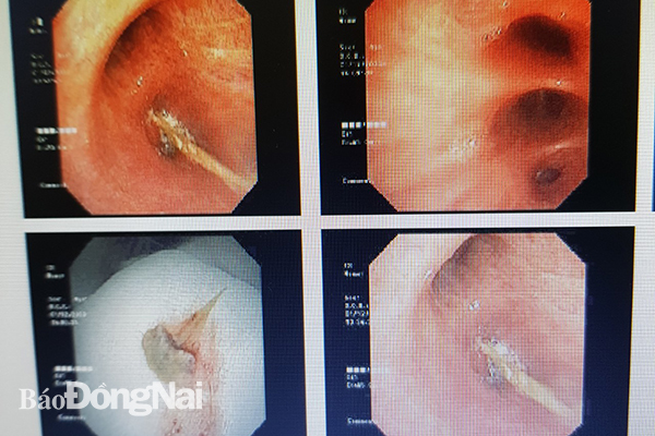 Gắp xương cá ở đâu? Gallery 1