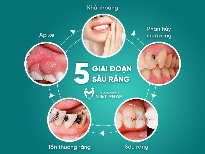 Sâu răng có hình dạng như thế nào? Gallery 1
