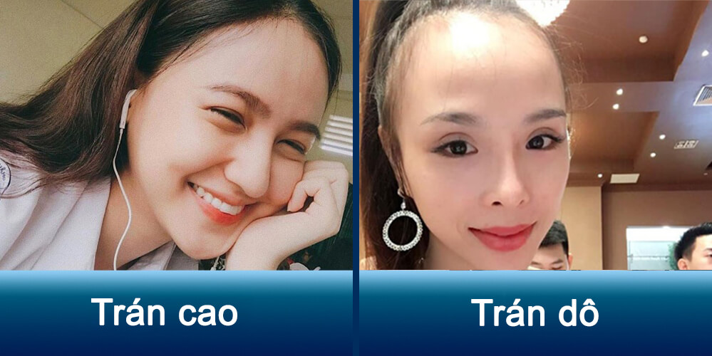 Phụ nữ trán cao và dô: Bí quyết làm đẹp và tự tin tỏa sáng Gallery 2