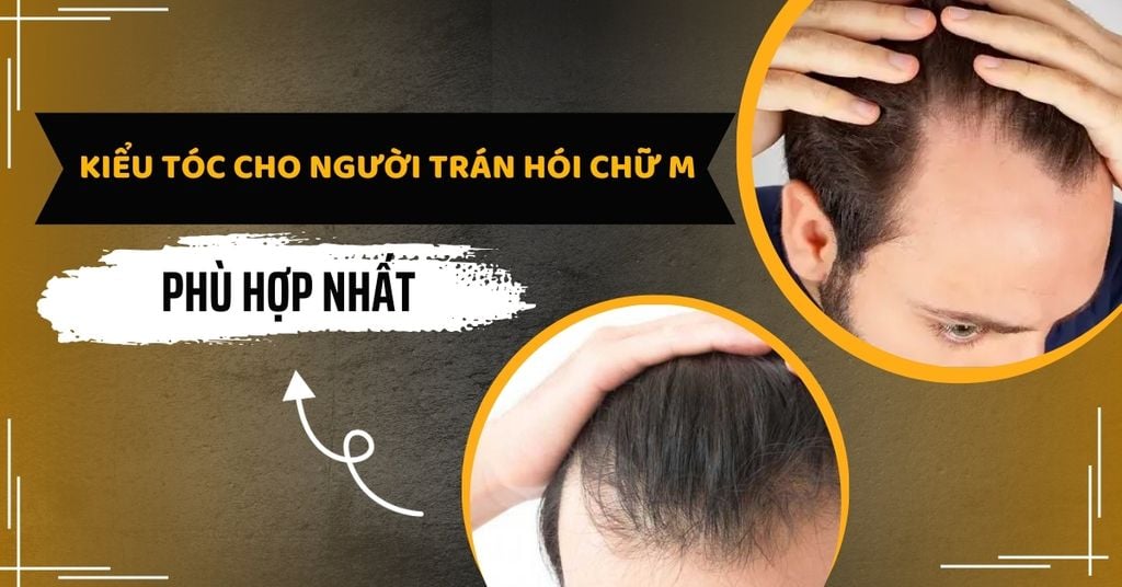 Trán chữ M nam để tóc gì? Gallery 1
