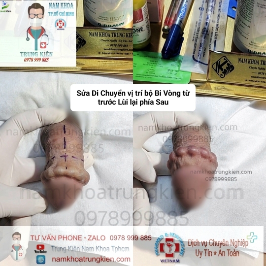 Độ Bi Cậu Nhỏ Là Gì? Gallery 1