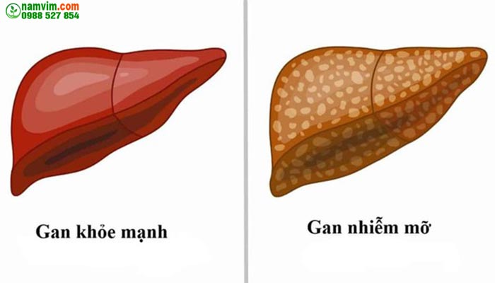 Gan Nhiễm Mỡ Tiếng Anh Là Gì Gallery 1