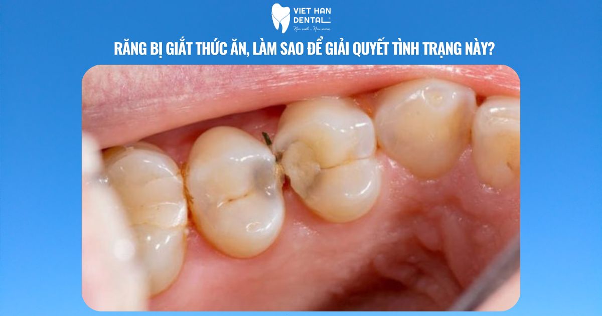 Giắt Răng: Hướng Dẫn Chi Tiết Từ A Đến Z Gallery 1