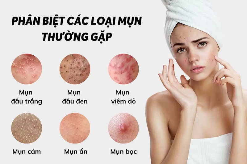 Cách Trị Mụn Hiệu Quả Và An Toàn Gallery 1