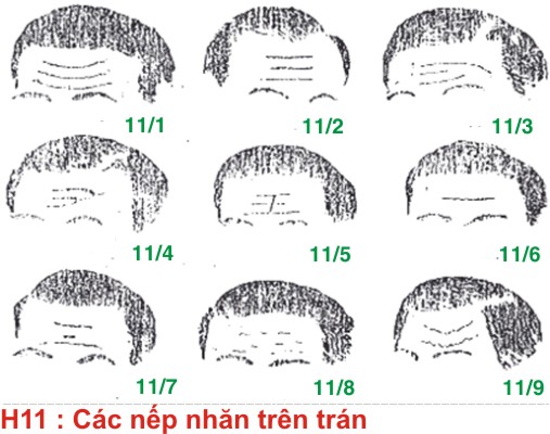 Trán Nhăn Tướng Số: Giải Mã Bí Ẩn Vận Mệnh Gallery 1