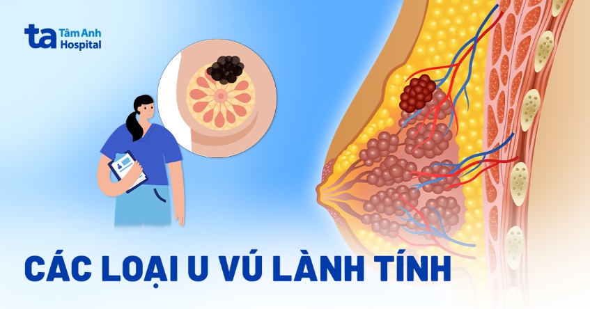 U Ưu Là Gì? Tìm Hiểu Về U Ưu Và Những Điều Cần Biết Gallery 1