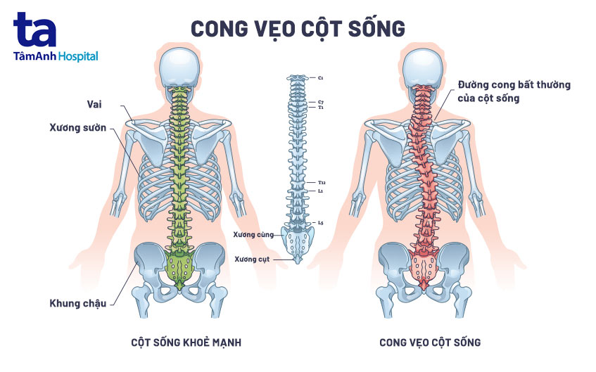 Xiêu Vẹo Là Gì? Định Nghĩa, Nguyên Nhân Và Cách Khắc Phục Gallery 1