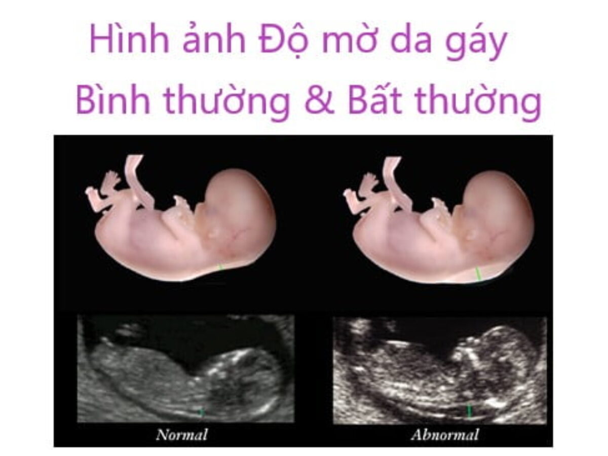 Nguyên nhân độ mờ da gáy cao Gallery 1