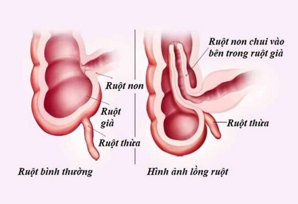 Nguyên Nhân Trẻ Bị Lồng Ruột Gallery 1