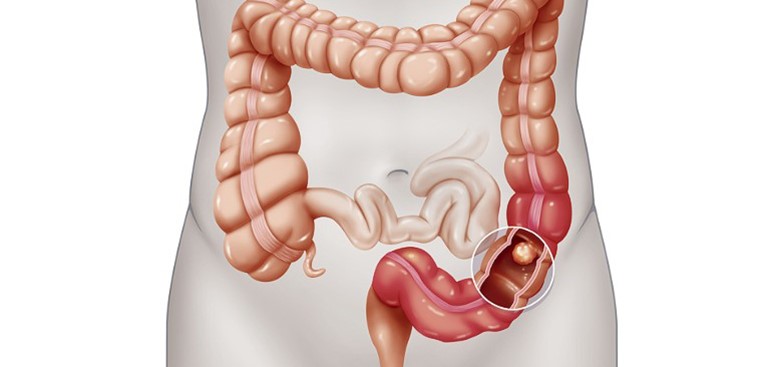 Sờ Thấy Cục Cứng Ở Bụng Dưới Bên Phải: Nguyên Nhân Và Cách Xử Lý Gallery 1
