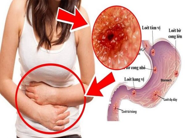 Đau Bên Trái Dưới Sườn: Nguyên Nhân Và Cách Khắc Phục Gallery 1