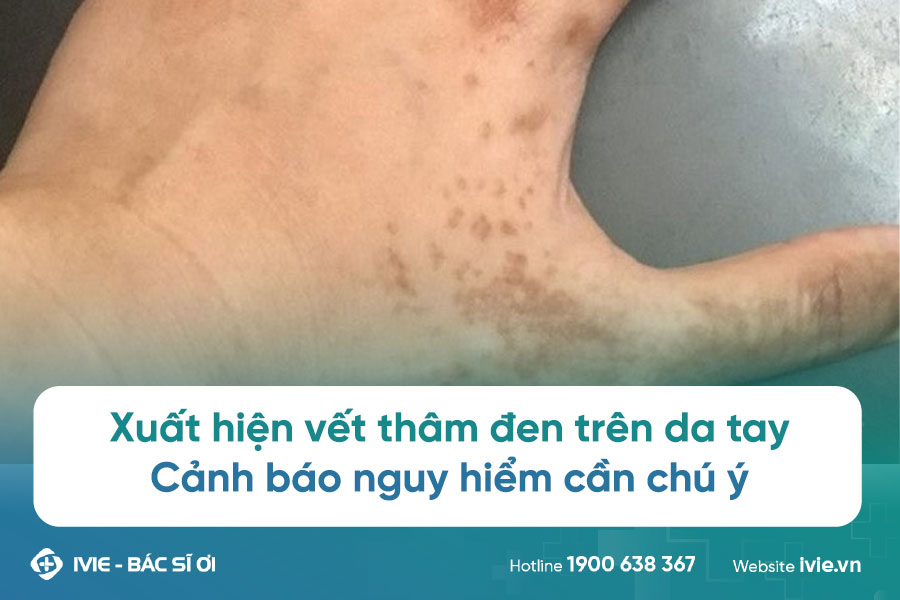 Tay bị nổi đốm đen là bị gì? Gallery 1