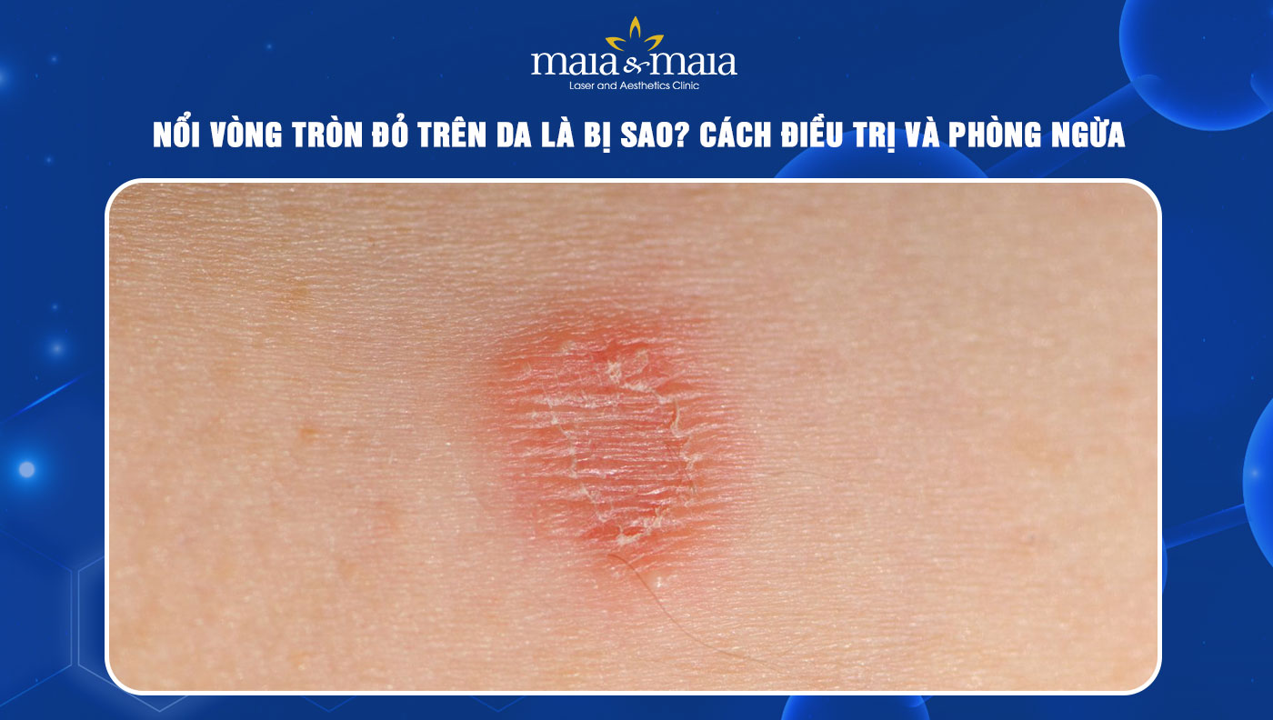 Đốm Bị Nổi Vòng Tròn Đỏ Trên Da: Nguyên Nhân, Triệu Chứng & Cách Điều Trị Gallery 1