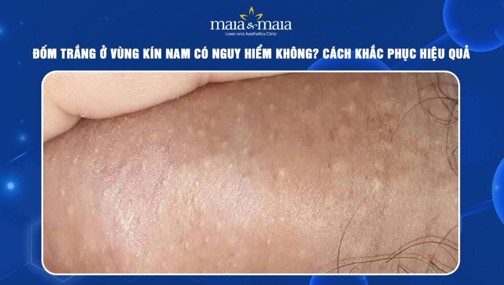 Dương vật có đốm trắng: Nguyên nhân và cách xử lý Gallery 1