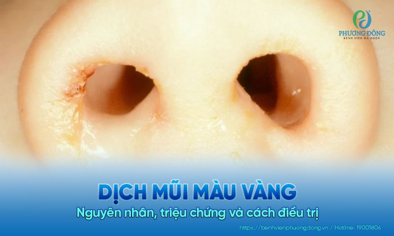 Nước mũi màu vàng là bị gì? Gallery 1