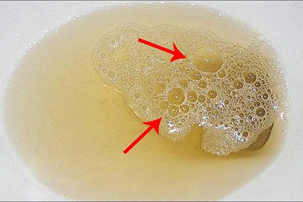 Rì bọt là gì?