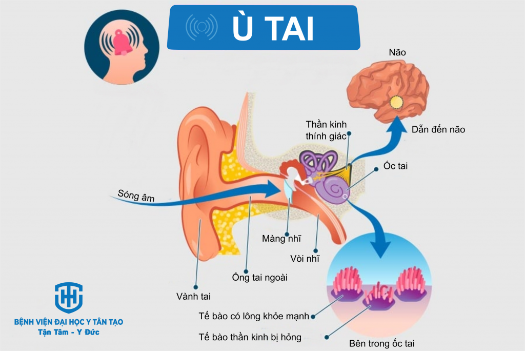 Ù tai là triệu chứng gì? Gallery 1
