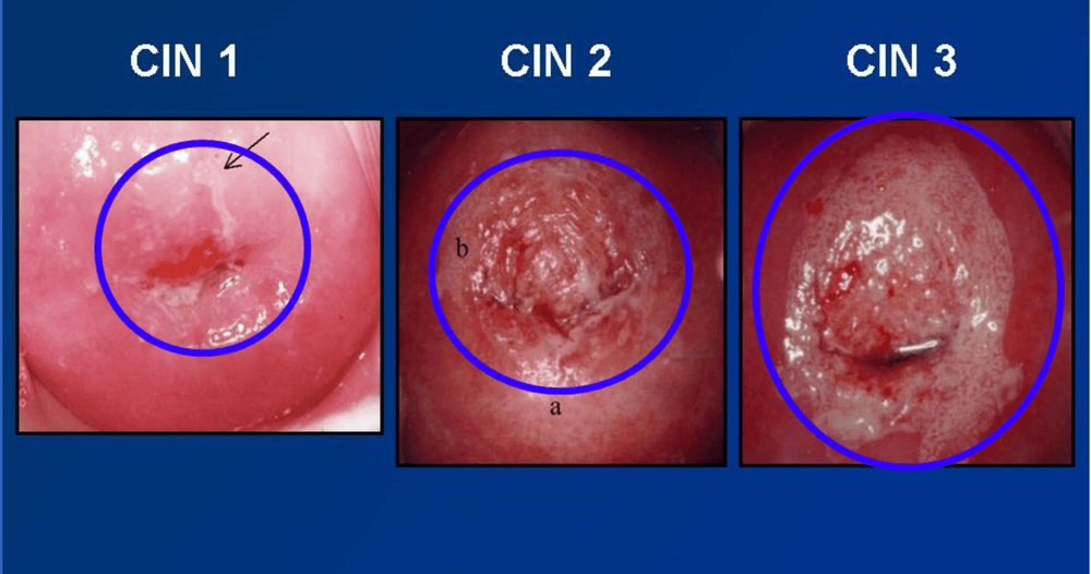 Cách Điều Trị CIN 3 Gallery 1