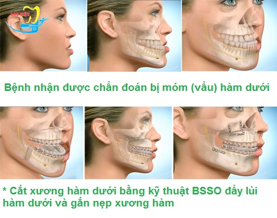Làm Sao Để Hết Móm Tại Nhà? Gallery 1