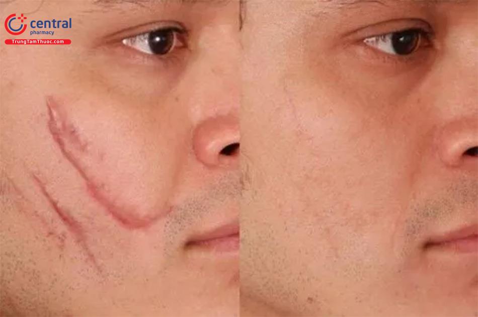 Cách Làm Liền Sẹo Trên Mặt Hiệu Quả Gallery 1