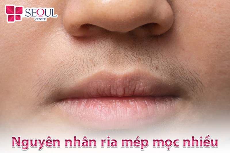 Cách Trị Ria Mép Hiệu Quả và An Toàn Gallery 1