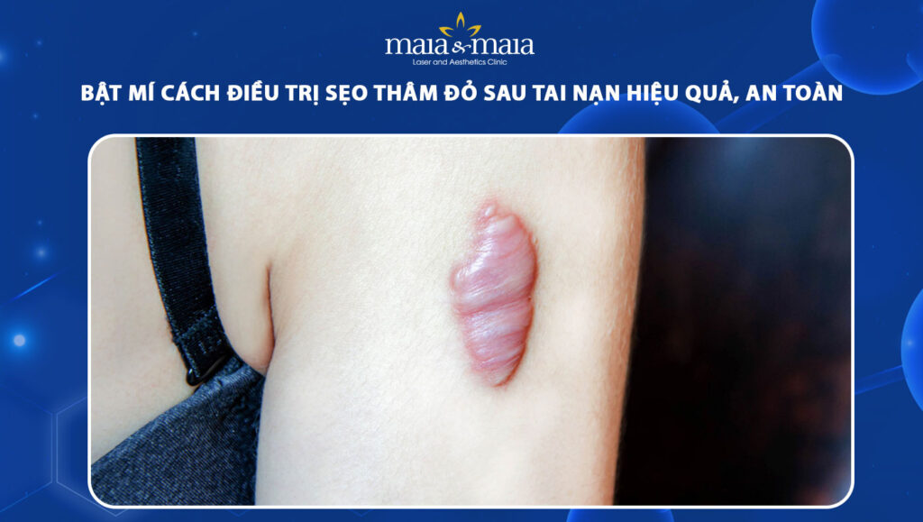 Cách Trị Sẹo Thâm Sau Tai Nạn Gallery 1
