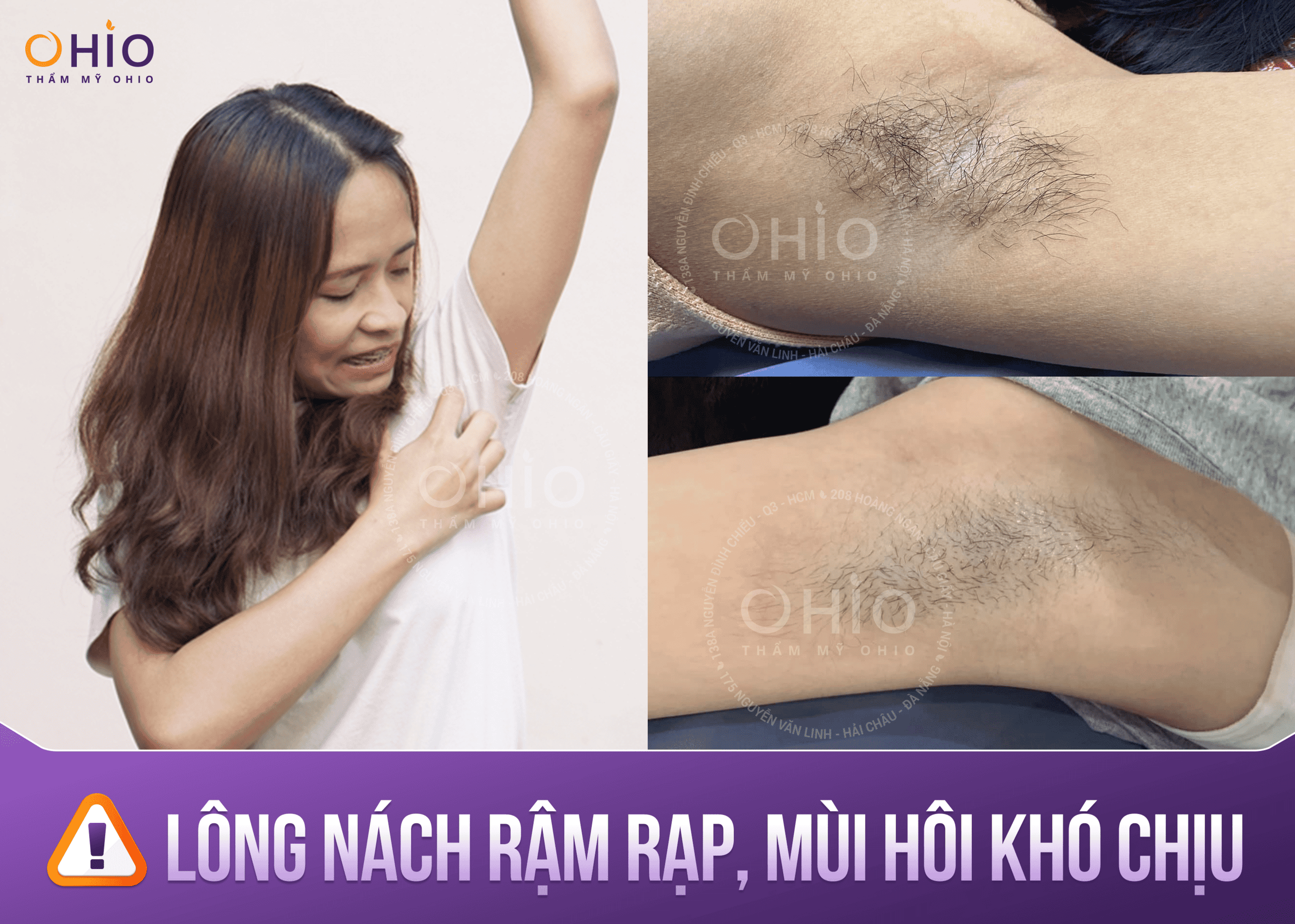 Làm Sao Để Lông Nách Không Mọc Nữa? Gallery 1