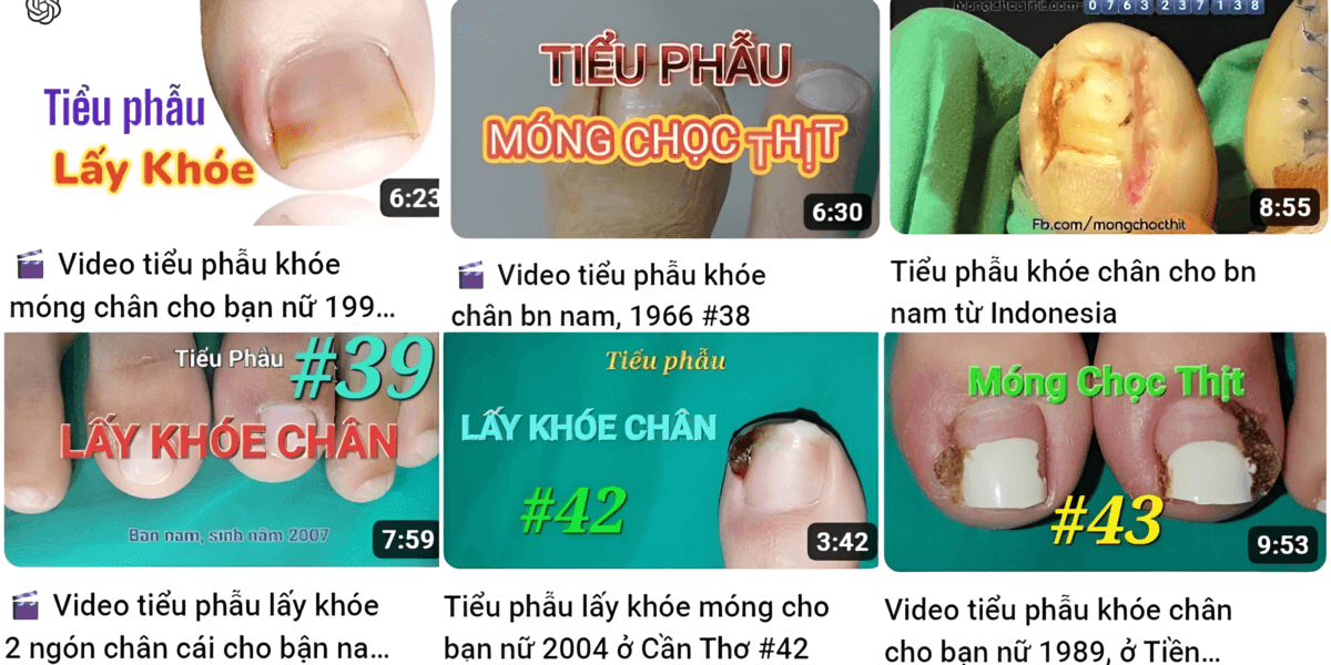 Lấy khóe móng chân ở đâu TPHCM? Gallery 1