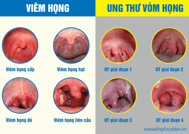 Triệu chứng ung thư vòm họng Gallery 1