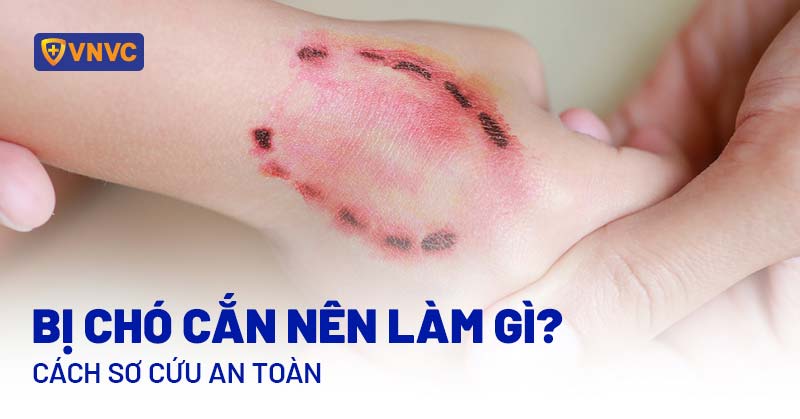 Triệu chứng sau khi bị chó cào: Cần làm gì khi bị chó cào? Gallery 1