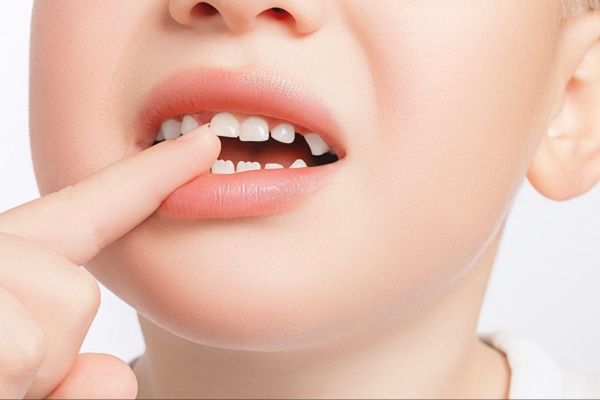 Trẻ bị gãy răng sữa có mọc lại không? Gallery 1