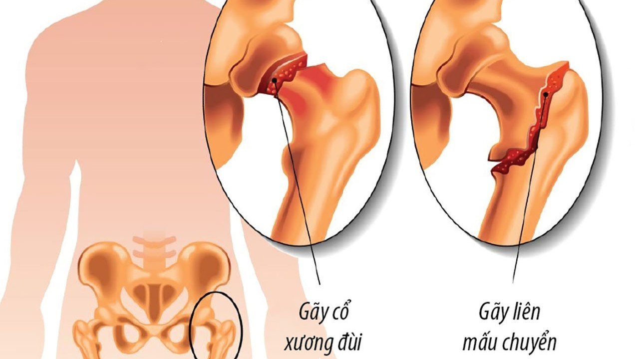 Mấu Chuyển Lớn Xương Cánh Tay Gallery 2