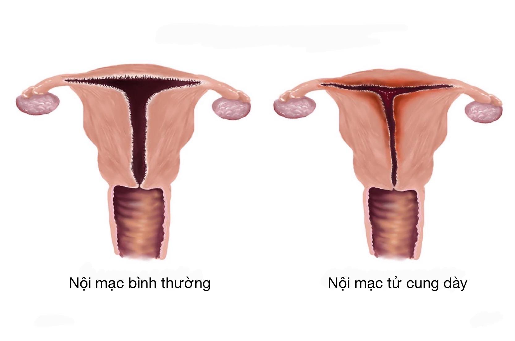Bề dày nội mạc tử cung bình thường là bao nhiêu? Gallery 2