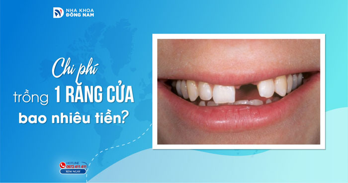 Trồng 1 cái răng bao nhiêu tiền? Gallery 1