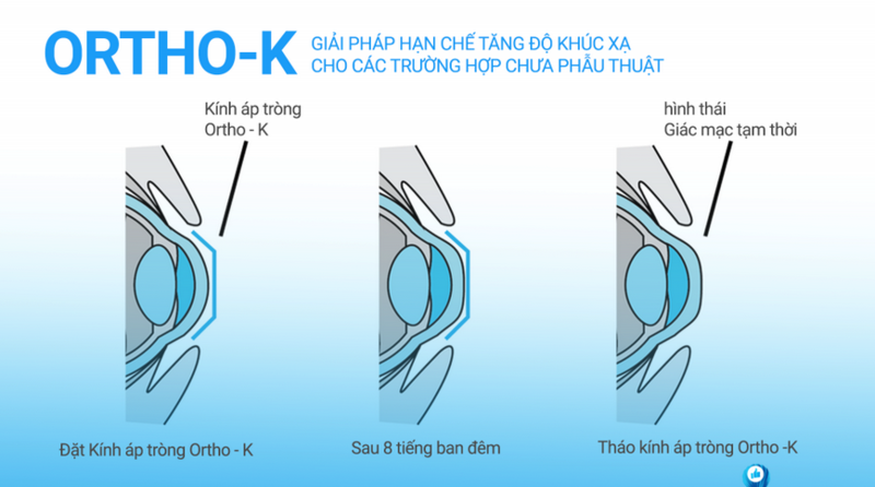 Kính Ortho-K Giá Bao Nhiêu? Gallery 1