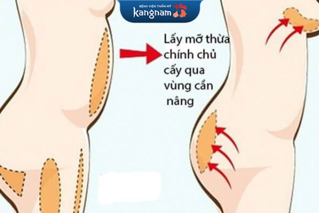 Nâng mông bằng mỡ tự thân bao nhiêu tiền? Gallery 1