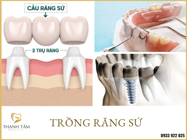 Trồng Răng Giả Bao Nhiêu 1 Chiếc? Gallery 1