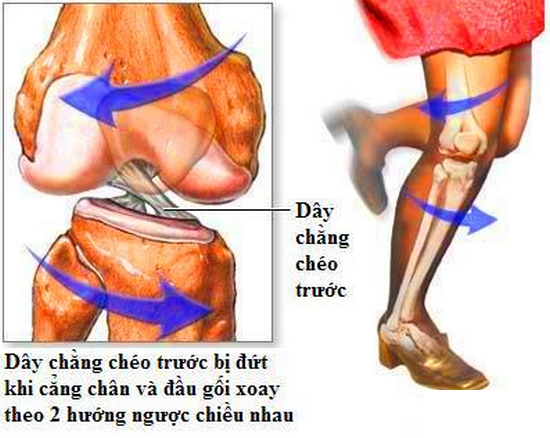 Đứt dây chằng có tự lành được không? Gallery 1