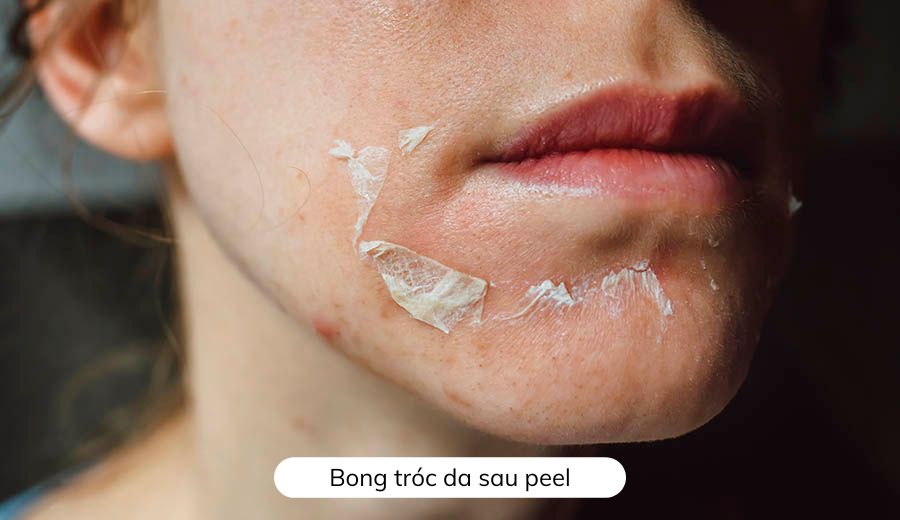 Lột da bao lâu thì bong lớp 2?