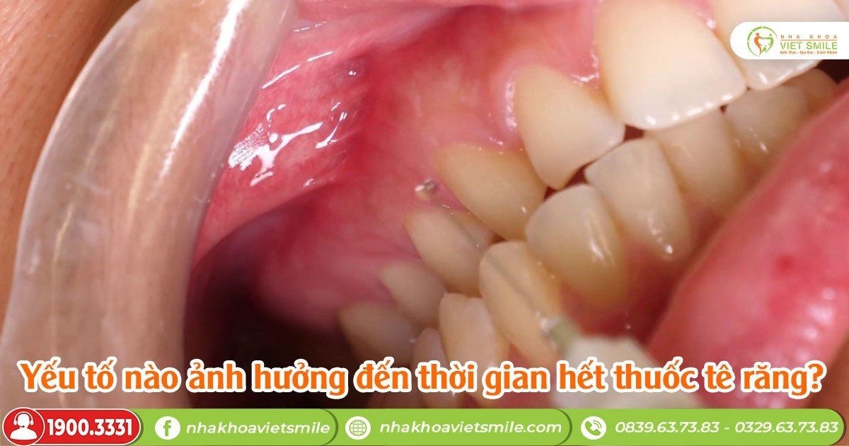 Thuốc Tê Nhổ Răng Bao Lâu Thì Hết? Gallery 1