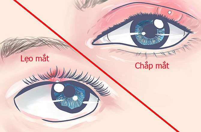 Chắp mắt bao lâu thì khỏi? Gallery 1