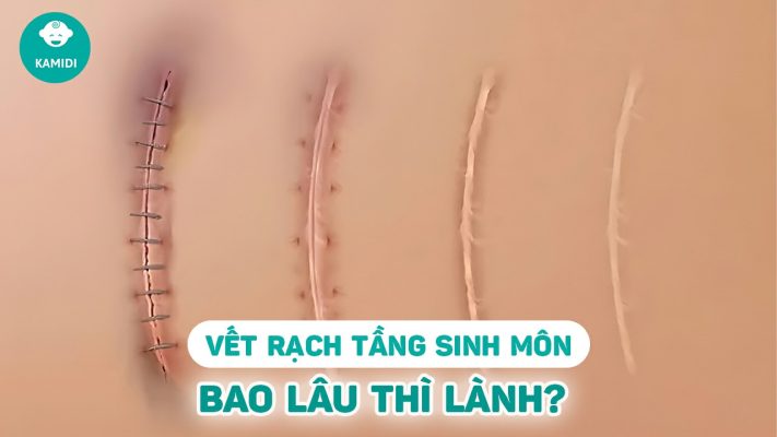 Vết May Tầng Sinh Môn Bao Lâu Thì Lành? Gallery 1